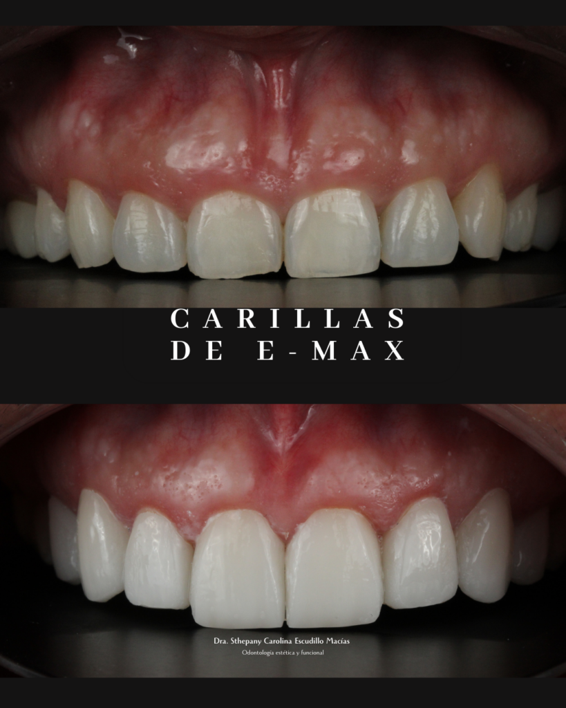 Carillas porcelana Dra. Sthepany Escudillo