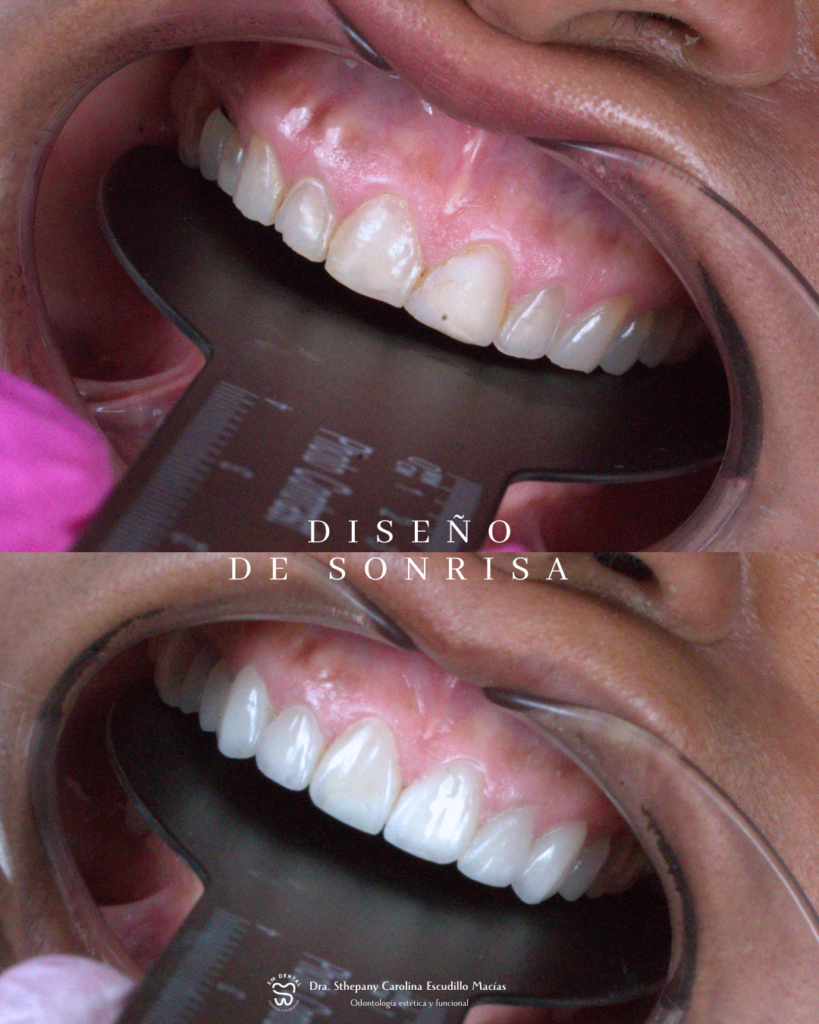 Diseño de sonrisa